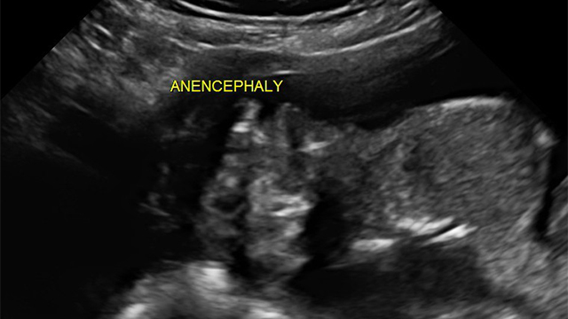 Foetal abnormality: Anencephaly